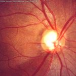 Glaucoma, il nemico silenzioso della vista