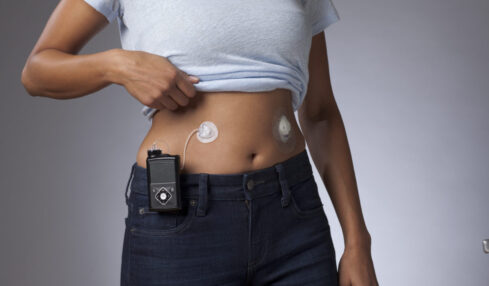 MiniMed Mio Advance di Medtronic vera innovazione per i diabetici