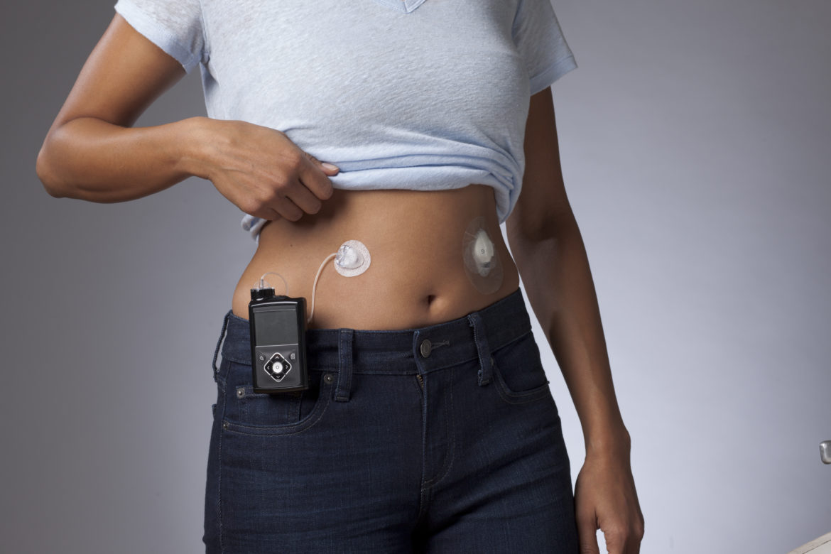 MiniMed Mio Advance di Medtronic vera innovazione per i diabetici