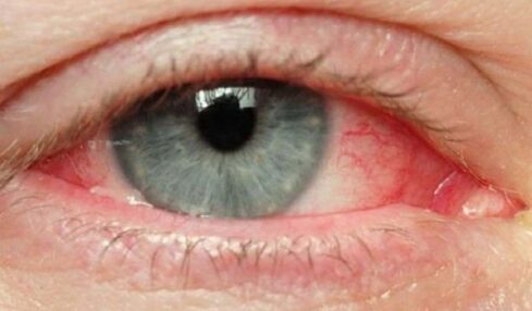 Giornata mondiale della vista: curare l’occhio secco per evitare problemi più seri